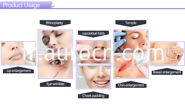 injection intra-articulaire d'acide hyaluronique hyaluronic acid intra-articular injection